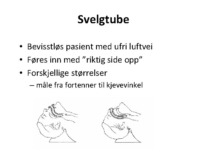 Svelgtube • Bevisstløs pasient med ufri luftvei • Føres inn med ”riktig side opp”