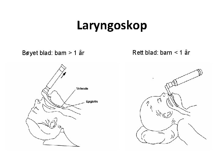 Laryngoskop Bøyet blad: barn > 1 år Rett blad: barn < 1 år 