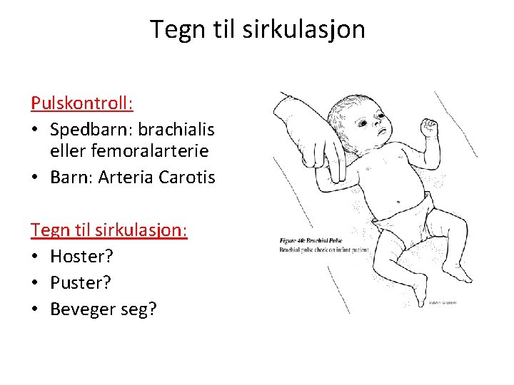 Tegn til sirkulasjon Pulskontroll: • Spedbarn: brachialis eller femoralarterie • Barn: Arteria Carotis Tegn