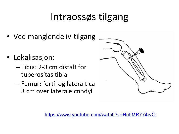 Intraossøs tilgang • Ved manglende iv-tilgang • Lokalisasjon: – Tibia: 2 -3 cm distalt