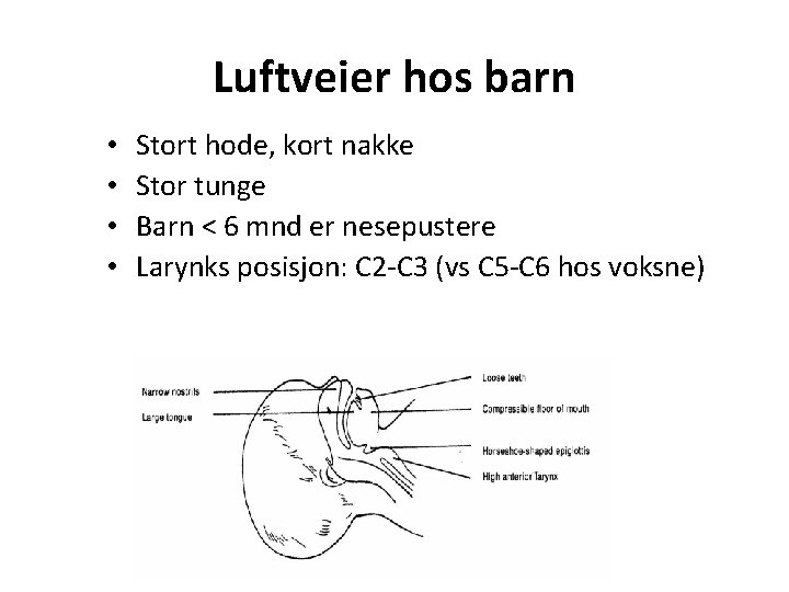 Luftveier hos barn • • Stort hode, kort nakke Stor tunge Barn < 6