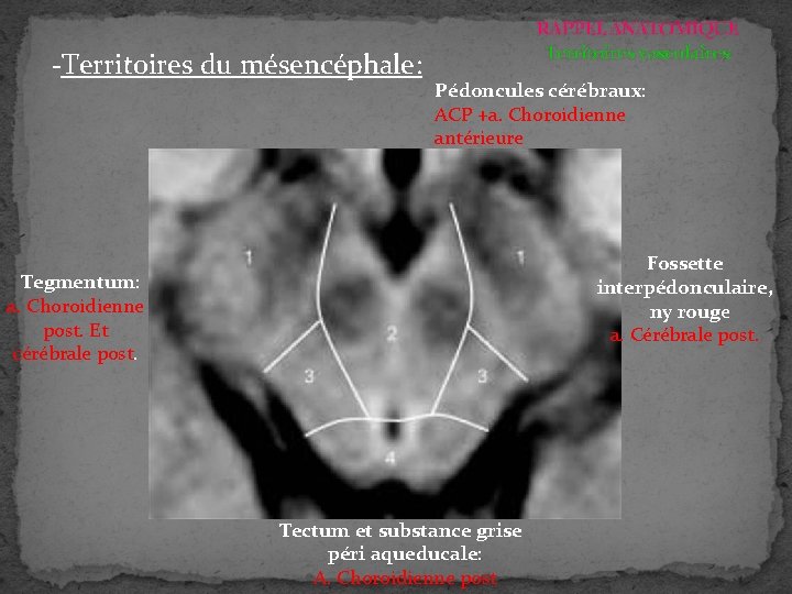 -Territoires du mésencéphale: RAPPEL ANATOMIQUE Territoires vasculaires Pédoncules cérébraux: ACP +a. Choroidienne antérieure Fossette