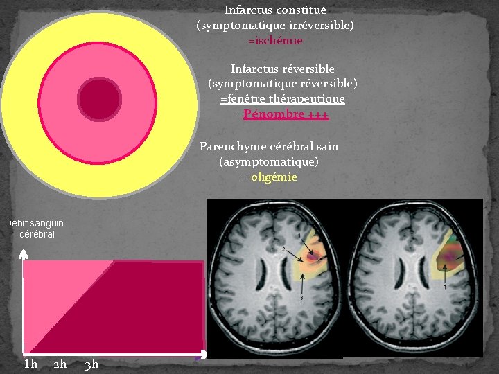 Infarctus constitué (symptomatique irréversible) =ischémie Infarctus réversible (symptomatique réversible) =fenêtre thérapeutique =Pénombre +++ Parenchyme