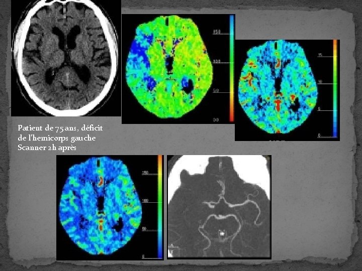 Patient de 75 ans, déficit de l’hemicorps gauche Scanner 2 h après 