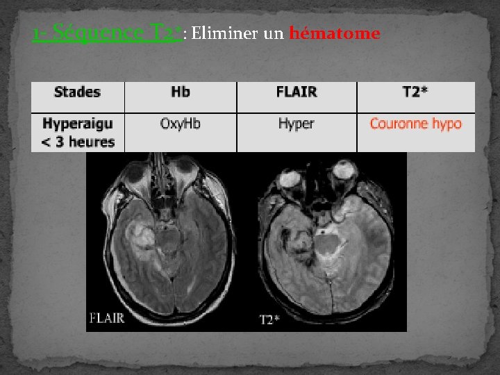 1 - Séquence T 2*: Eliminer un hématome 