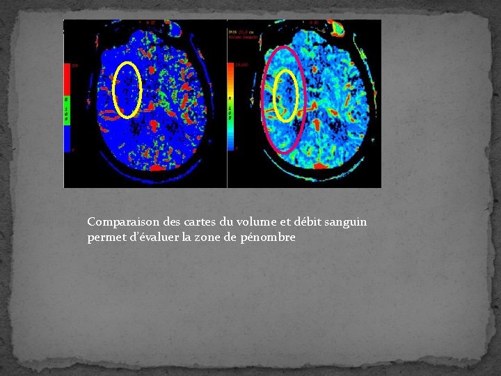 Comparaison des cartes du volume et débit sanguin permet d’évaluer la zone de pénombre