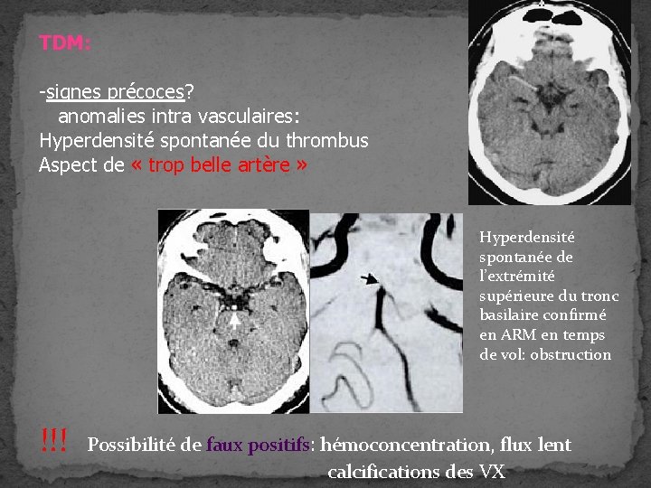 TDM: -signes précoces? anomalies intra vasculaires: Hyperdensité spontanée du thrombus Aspect de « trop