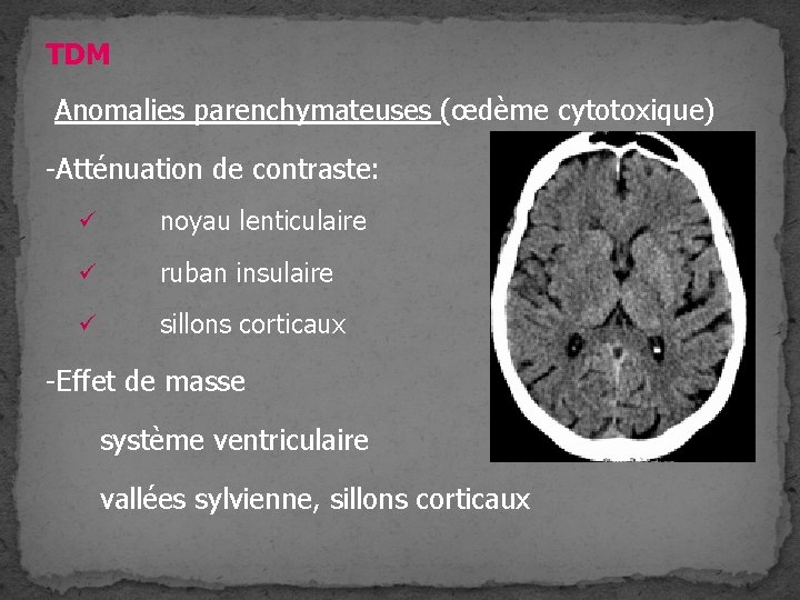 TDM Anomalies parenchymateuses (œdème cytotoxique) -Atténuation de contraste: ü noyau lenticulaire ü ruban insulaire TDM Anomalies parenchymateuses (œdème cytotoxique) -Atténuation de contraste: ü noyau lenticulaire ü ruban insulaire