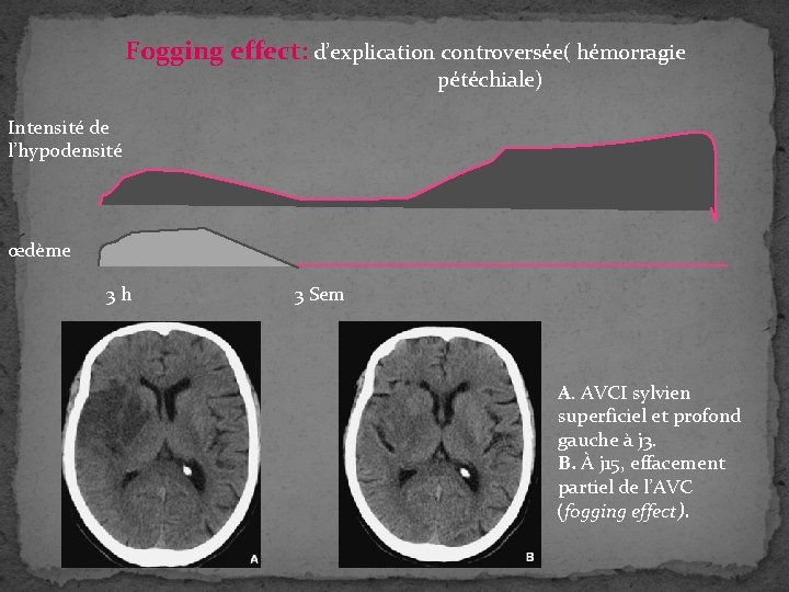 Fogging effect: d’explication controversée( hémorragie pétéchiale) Intensité de l’hypodensité œdème 3 h 3 Sem