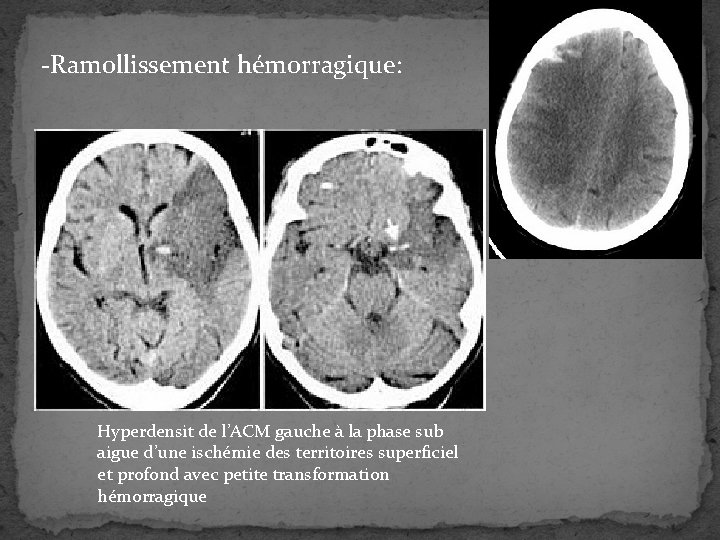 -Ramollissement hémorragique: Hyperdensit de l’ACM gauche à la phase sub aigue d’une ischémie des