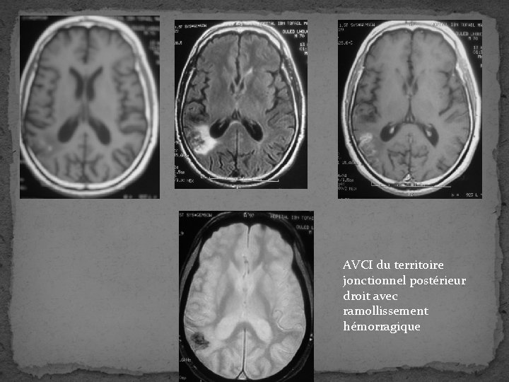AVCI du territoire jonctionnel postérieur droit avec ramollissement hémorragique 