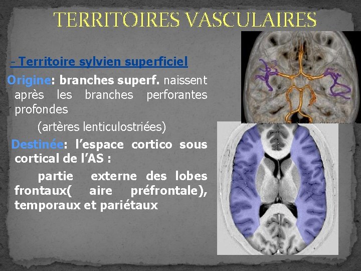 TERRITOIRES VASCULAIRES - Territoire sylvien superficiel Origine: branches superf. naissent après les branches perforantes