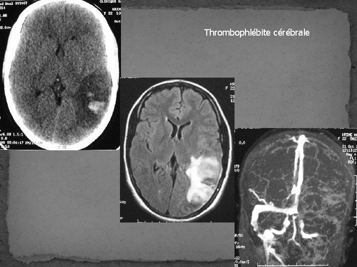 Thrombophlébite cérébrale Thrombophlébite cérébrale