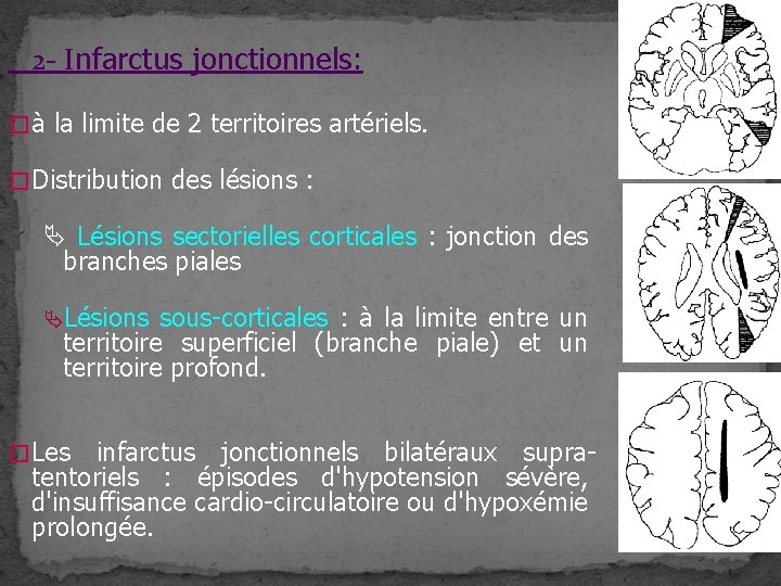 2 - Infarctus jonctionnels: � à la limite de 2 territoires artériels. � Distribution 2 - Infarctus jonctionnels: � à la limite de 2 territoires artériels. � Distribution