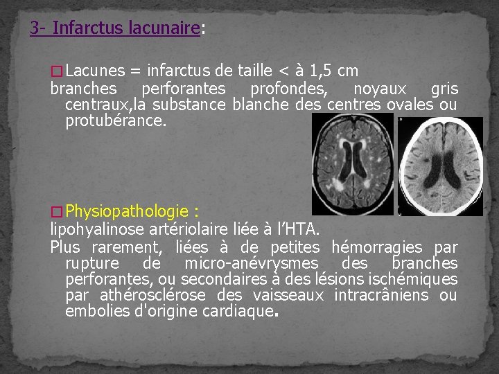 3 - Infarctus lacunaire: � Lacunes = infarctus de taille < à 1, 5 3 - Infarctus lacunaire: � Lacunes = infarctus de taille < à 1, 5