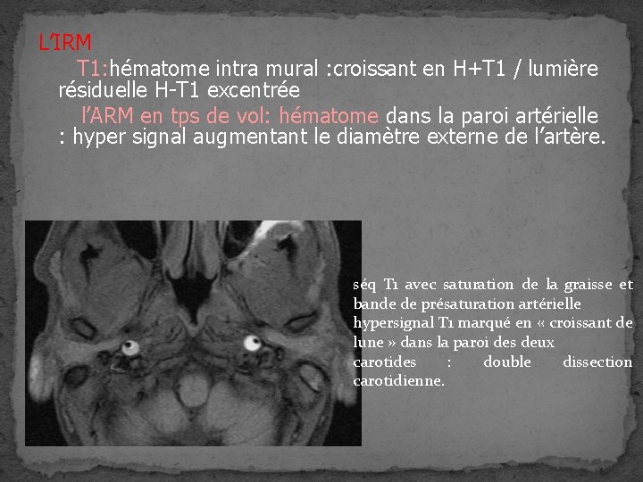 L’IRM T 1: hématome intra mural : croissant en H+T 1 / lumière résiduelle L’IRM T 1: hématome intra mural : croissant en H+T 1 / lumière résiduelle