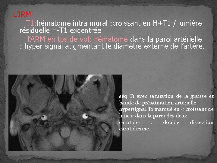 L’IRM T 1: hématome intra mural : croissant en H+T 1 / lumière résiduelle