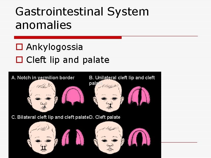 Gastrointestinal System anomalies o Ankylogossia o Cleft lip and palate A. Notch in vermilion