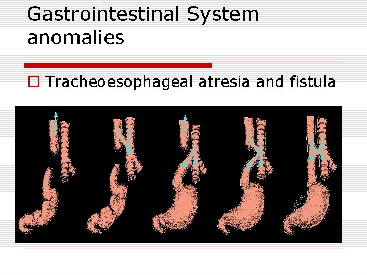 Gastrointestinal System anomalies o Tracheoesophageal atresia and fistula 