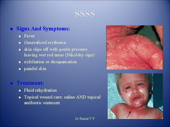 SSSS n Signs And Symptoms: n n n Fever Generalized erythema skin slips off