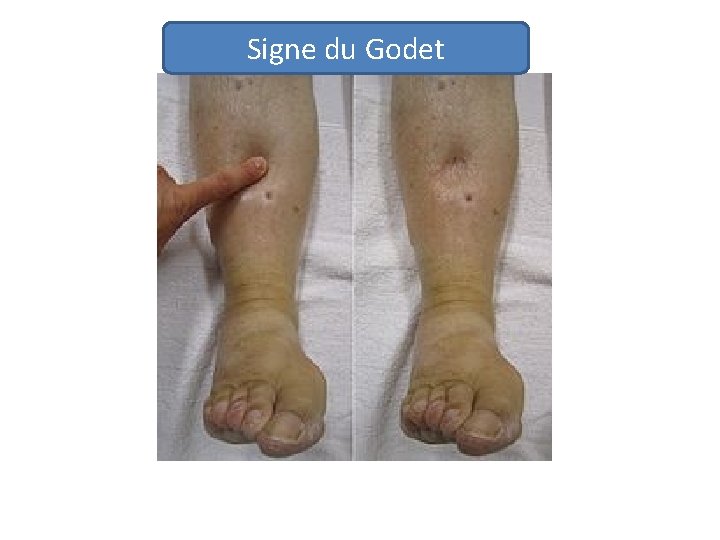 Signe du Godet 