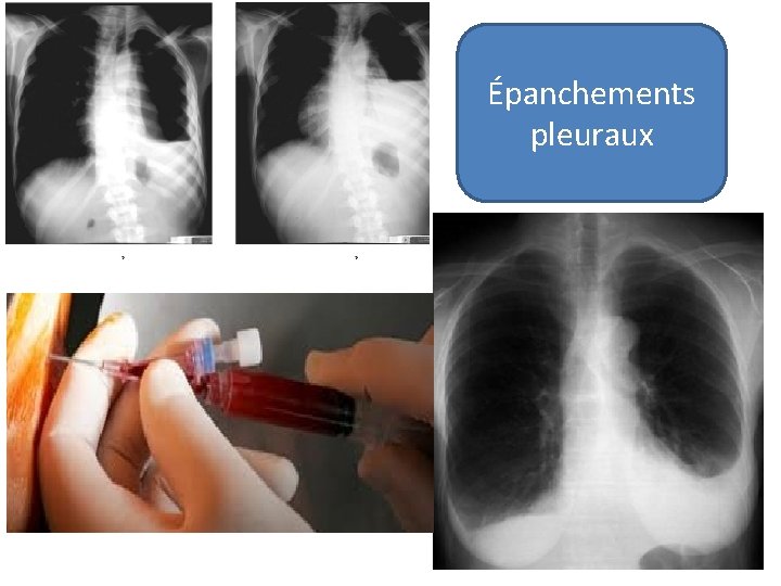 Épanchements pleuraux 