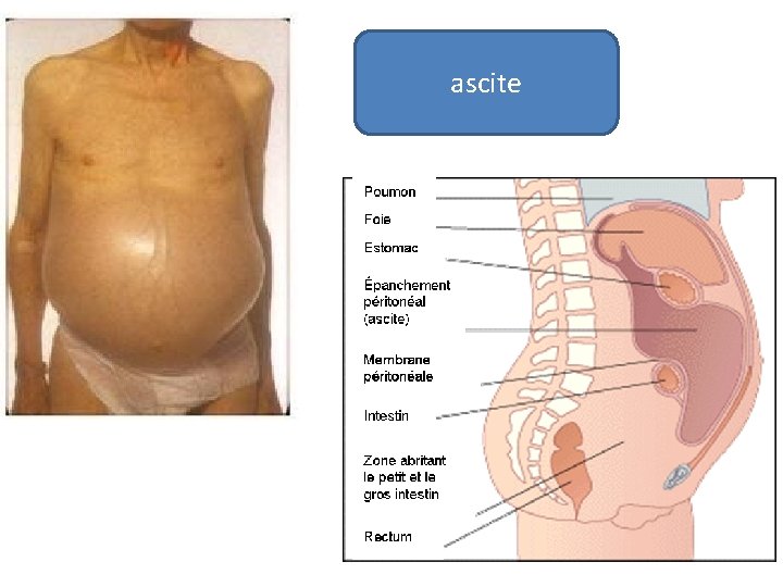 ascite 