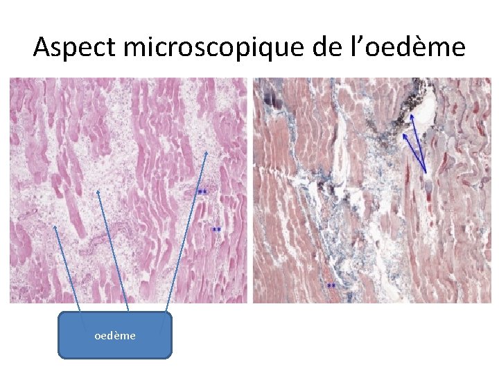 Aspect microscopique de l’oedème 