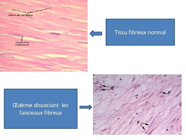 Tissu fibreux normal Œdème dissociant les faisceaux fibreux 