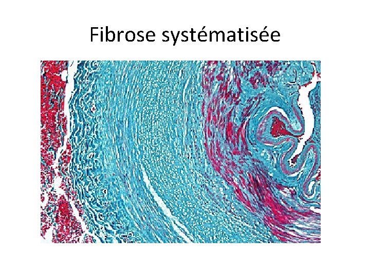 Fibrose systématisée 