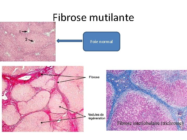 Fibrose mutilante Foie normal 