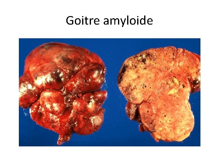 Goitre amyloide 