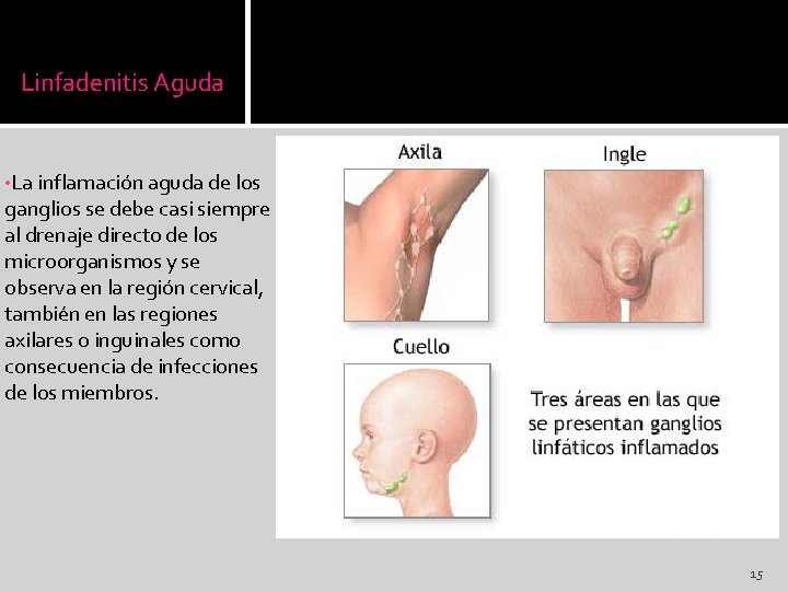 Linfadenitis Aguda • La inflamación aguda de los ganglios se debe casi siempre al