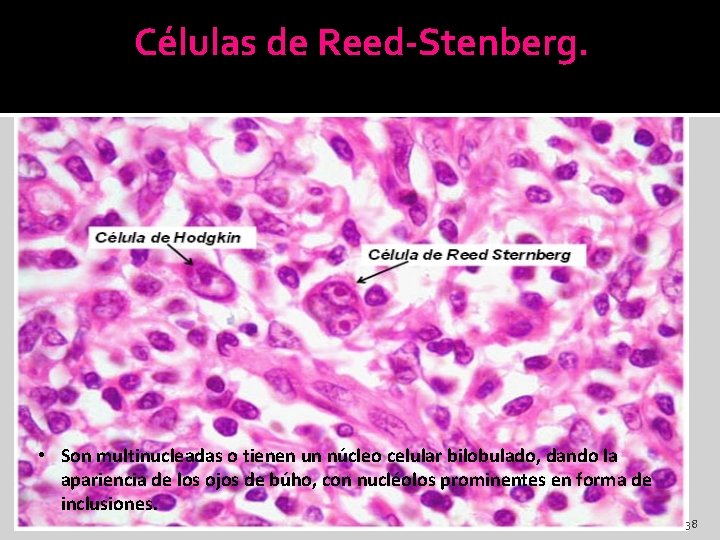Células de Reed-Stenberg. • Son multinucleadas o tienen un núcleo celular bilobulado, dando la