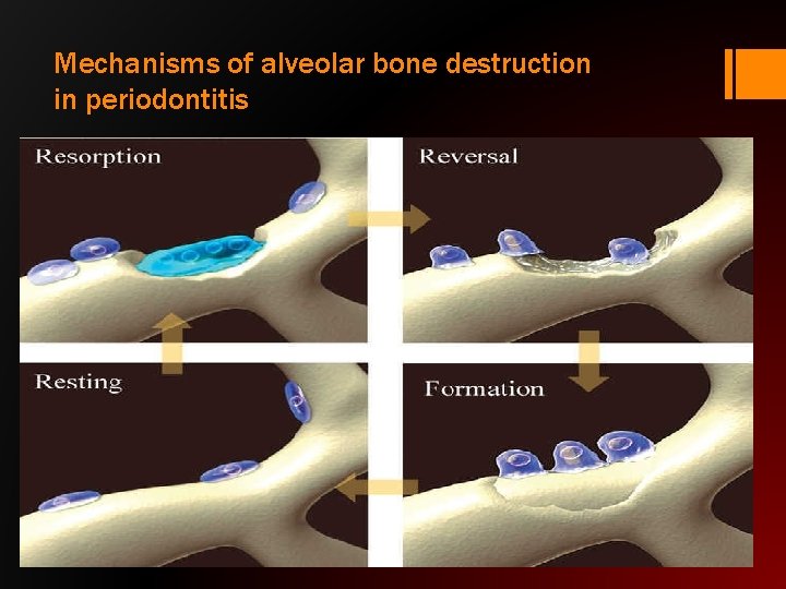 Mechanisms of alveolar bone destruction in periodontitis 