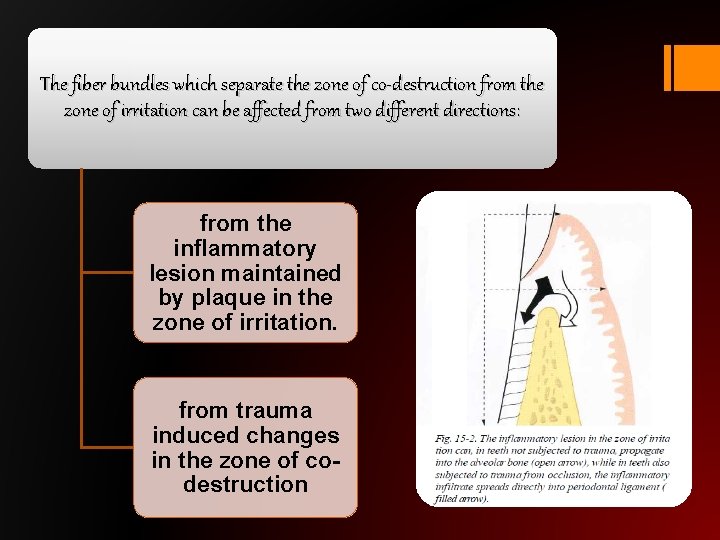 The fiber bundles which separate the zone of co-destruction from the zone of irritation