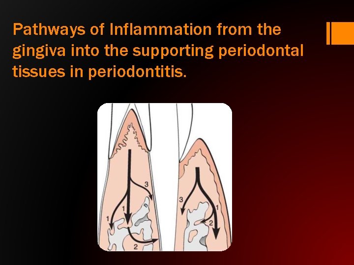 Pathways of Inflammation from the gingiva into the supporting periodontal tissues in periodontitis. 