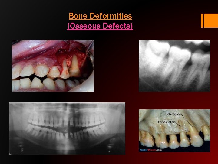 Bone Deformities (Osseous Defects) 