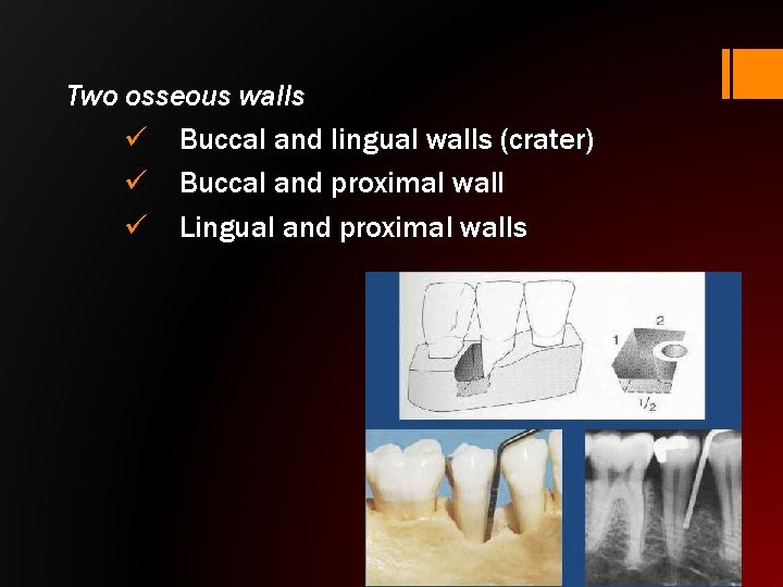 Two osseous walls ü Buccal and lingual walls (crater) ü Buccal and proximal wall