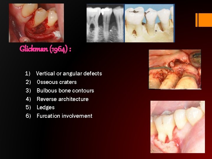 Glickman (1964) : 1) Vertical or angular defects 2) Osseous craters 3) Bulbous bone