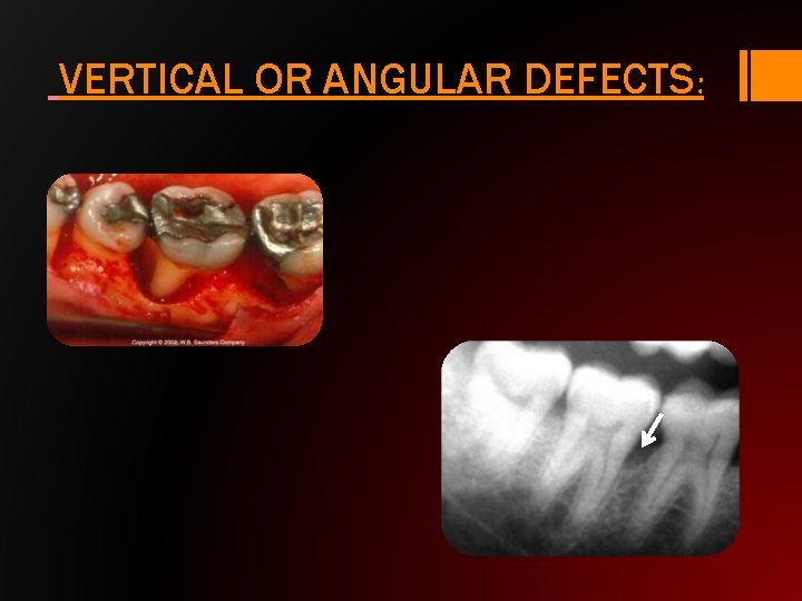 VERTICAL OR ANGULAR DEFECTS: 