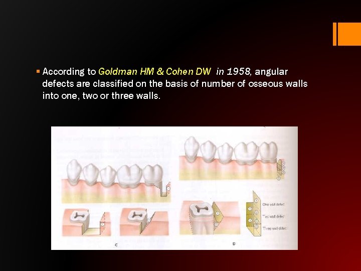 § According to Goldman HM & Cohen DW in 1958, angular defects are classified