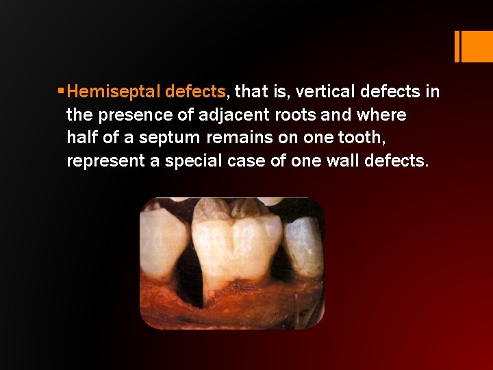 § Hemiseptal defects, that is, vertical defects in the presence of adjacent roots and