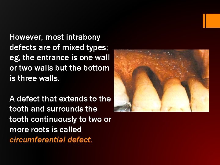 However, most intrabony defects are of mixed types; eg, the entrance is one wall
