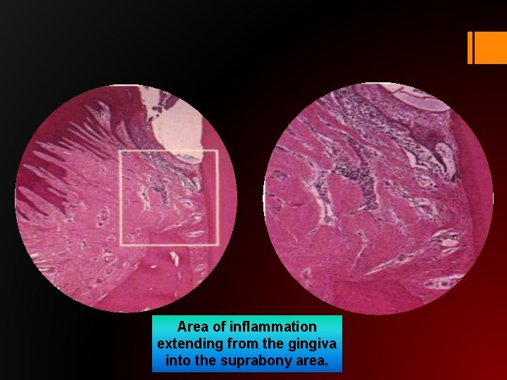 Area of inflammation extending from the gingiva into the suprabony area. 