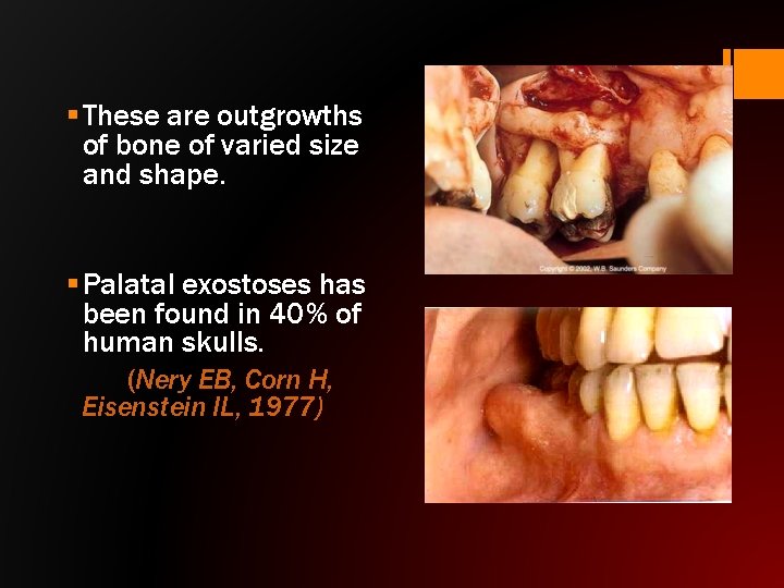 § These are outgrowths of bone of varied size and shape. § Palatal exostoses