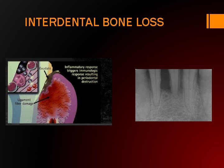 INTERDENTAL BONE LOSS 