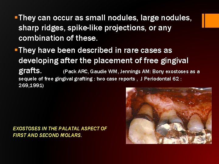 § They can occur as small nodules, large nodules, sharp ridges, spike-like projections, or