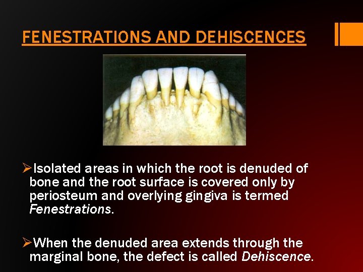 FENESTRATIONS AND DEHISCENCES ØIsolated areas in which the root is denuded of bone and