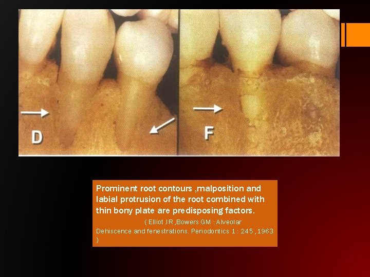 Prominent root contours , malposition and labial protrusion of the root combined with thin